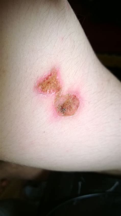 Burning Blister Wound Scab Slough Crust Eschar Scurf | Flickr - Photo Sharing!