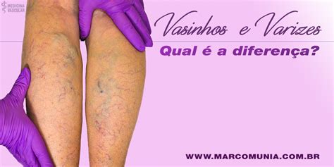 Varizes Dr Marco Munia