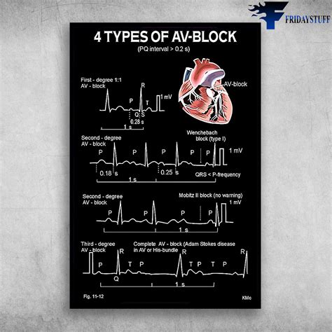 Av Heart Block Types