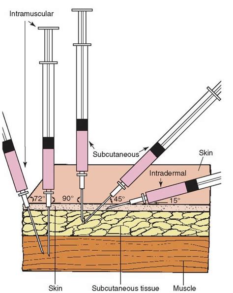 Injection Sites This Chart Shows You How To Apply Correctly