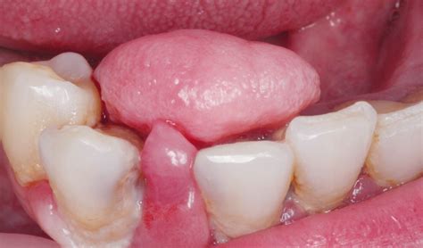 Cirugía bucal de un fibroma traumático Gaceta Dental