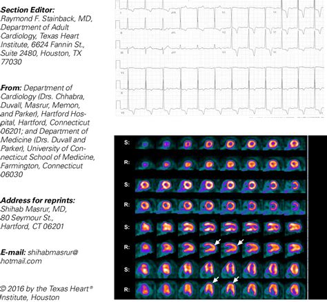 Figure From Spect Myocardial Perfusion Imaging In The Diagnosis Of