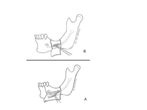 Inferior Alveolar Nerve Lateralization Ppt