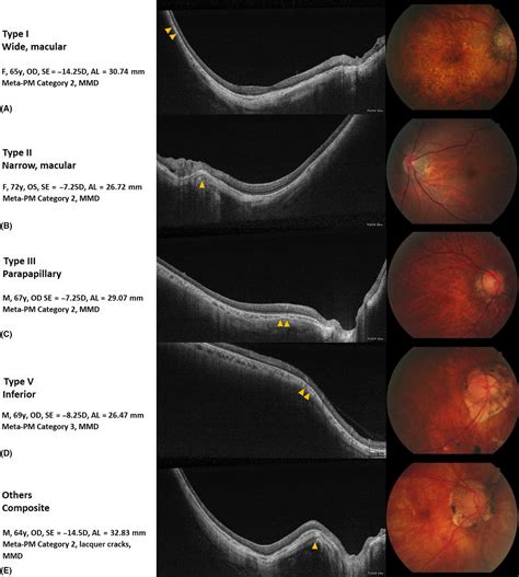 Staphyloma Mri