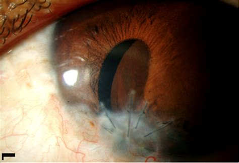 Woman with Iris Lesion and Vision Loss