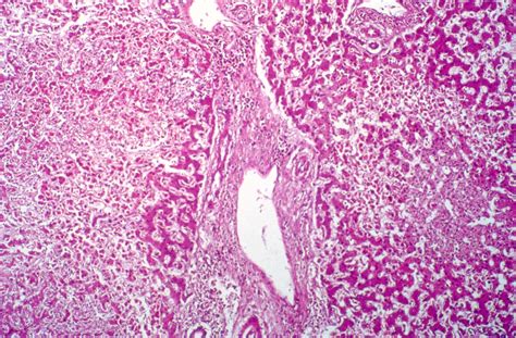 Histopathology Of Amoebic Liver Abscesses Sexiz Pix