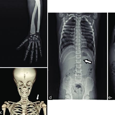 A X Ray Anterior Posterior Ap View Of Both Hands Shows The Mild