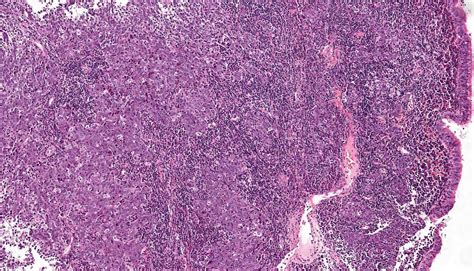 Pathology Outlines Nasopharyngeal Carcinoma