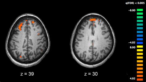 Undifferentiated schizophrenia disorder | General center | SteadyHealth.com