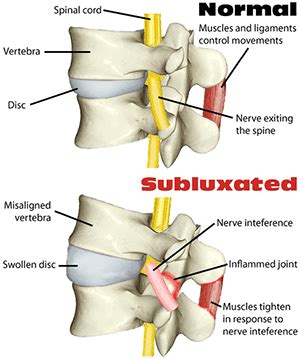 What is a Subluxation? - Chiropractor Altamonte Springs, FL | New Patient Special