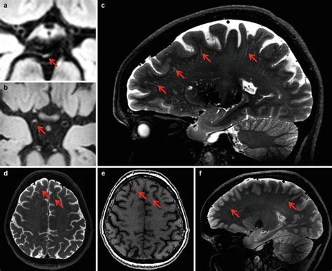 Cerebral Small Vessel