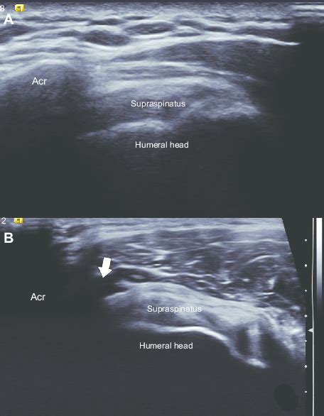 A And B Subacromial Impingement A Coronal Sonography View Of The