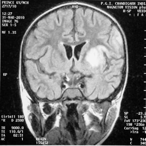 Pdf Contrast Enhanced Magnetic Resonance Imaging Mri Of The Brain Showing Infarct Involving