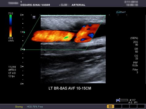 Av Fistula Ultrasound Worksheet