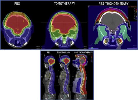 Medulloblastoma Proton And Photon Comparison Plans Left Proton Pencil Download Scientific