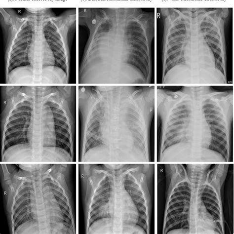 Chest X Ray Images From Kaggle Dataset A Normal Lung Image B Download Scientific Diagram