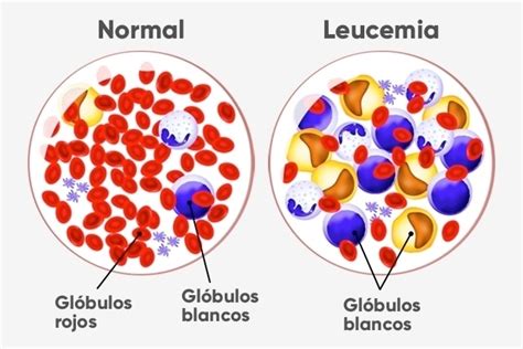 Tipos de leucemia en niños en adultos en jóvenes y mucho más