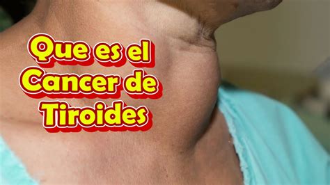 Que Es El Cancer De Tiroides Y Sus Sintomas Causas Y Tratamientos