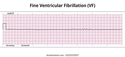 Fine Ventricular Fibrillation Vs Asystole