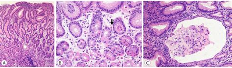 Histological Examinations Of Gastric Biopsy Specimens A Hyperplastic Download Scientific