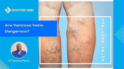 Are Varicose Veins Dangerous Doctor Vein