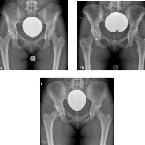 The Pelvic Radiographs Show Different Types Of Acetabular Orientation Download Scientific