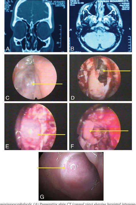 Figure 3 From Long Term Endonasal Endoscopic Review Of Successful