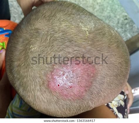 Tinea Capitis Fungal Infection On Scalp 스톡 사진 1363166417 Shutterstock