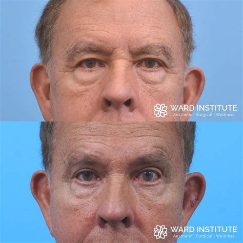 Blepharoplasty Plastic Surgery In Slc Ut Ward Institute