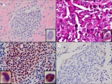 Sentinel Lymph Node Biopsy In Melanoma Pathology Overview Clinical