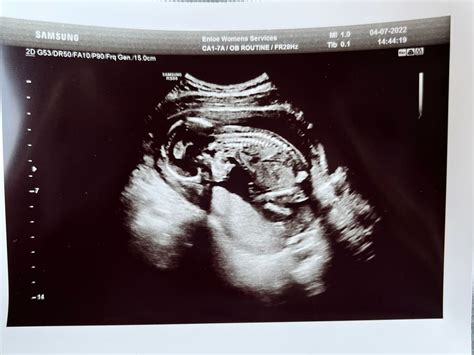 16 Week Ultrasounds September 2022 Babies Forums What To Expect