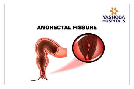 Non Surgical Simple Management For Anal Fissure With Botox Injection