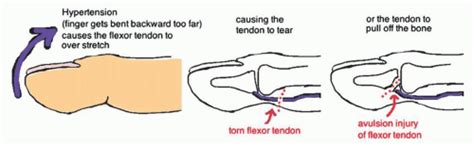 Jersey Finger | Musculoskeletal Key