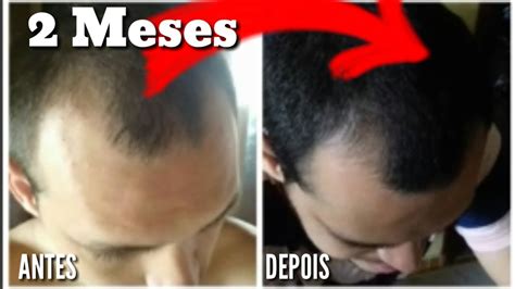 Minoxidil Antes E Depois Fim Da Calv Cie Youtube