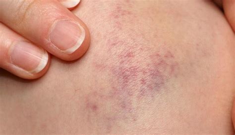 Easy Ways To Make Bruises Go Away Quickly