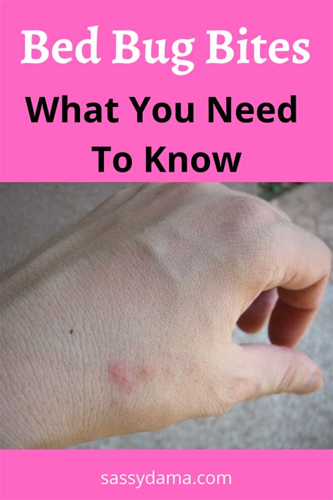 How To Treat Bed Bug Bites And Eliminate Infestation Rid Of Bed Bugs Bed Bug Bites Bed Bug