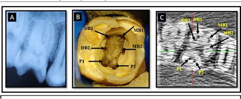 Figure From Endodontic Management Of Maxillary First Molar With Three