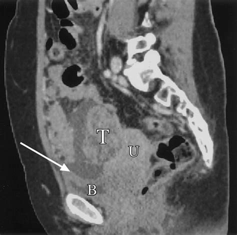 Multidetector Ct Of Peritoneal Carcinomatosis From Ovarian Cancer