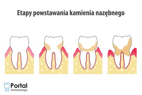 Jak powstaje kamień nazębny Portal Stomatologa