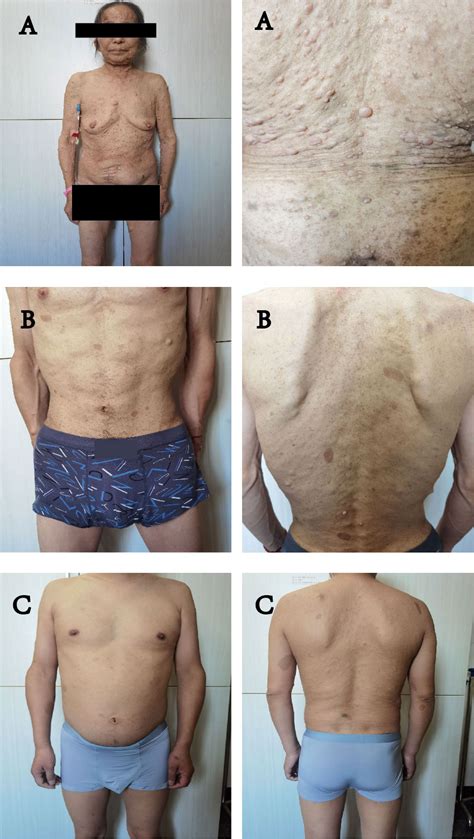 Frontiers Case Report Neurofibromatosis Type Gastrointestinal