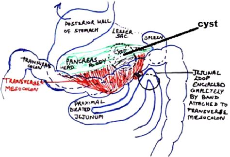 Transverse Mesocolon Pancreas