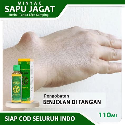 Obat Oles Penghancur Benjolan Ganglion Obat Kista Ganglion Obat