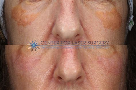 Xanthelasma Removal Washington Dc Center For Laser Surgery