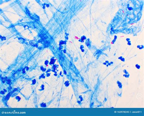 Mycobacterium Tuberculosis Positive in Sputum Smear Stock Image - Image ...