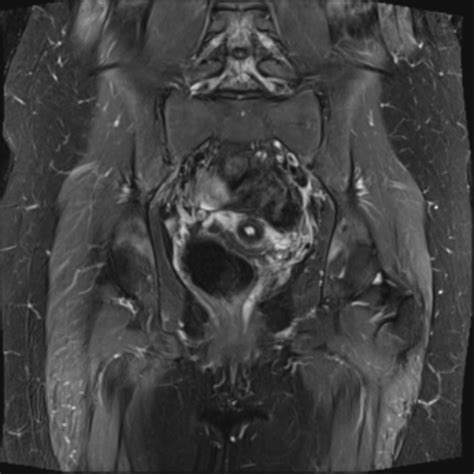 Tailgut Duplication Cyst Image Radiopaedia Org