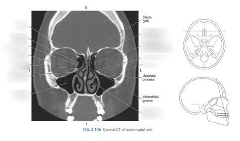 Diagram Of Coronal Ct Of Skull Quizlet