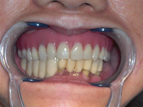 Dental Implantology Case Of Full Upper Full Denture Stabilization With