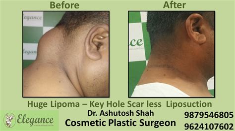 Reduction Of Lipoma Surgery In Hazira Surat Gujarat