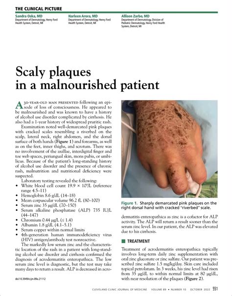 Zinc Deficiency Acrodermatitis Enteropathica