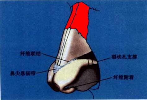 鼻骨内推手术能达到什么效果？手术是怎样操作的？有什么风险和后遗症？如何选择擅长鼻骨内推手术的医院医生？一篇文章看懂鼻骨内推！ 知乎